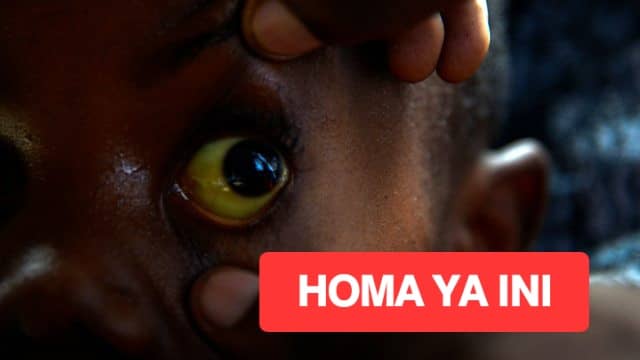 Fahamu kuhusu homa ya ini na virus vya Hepatitis (A, B, C, D na E)