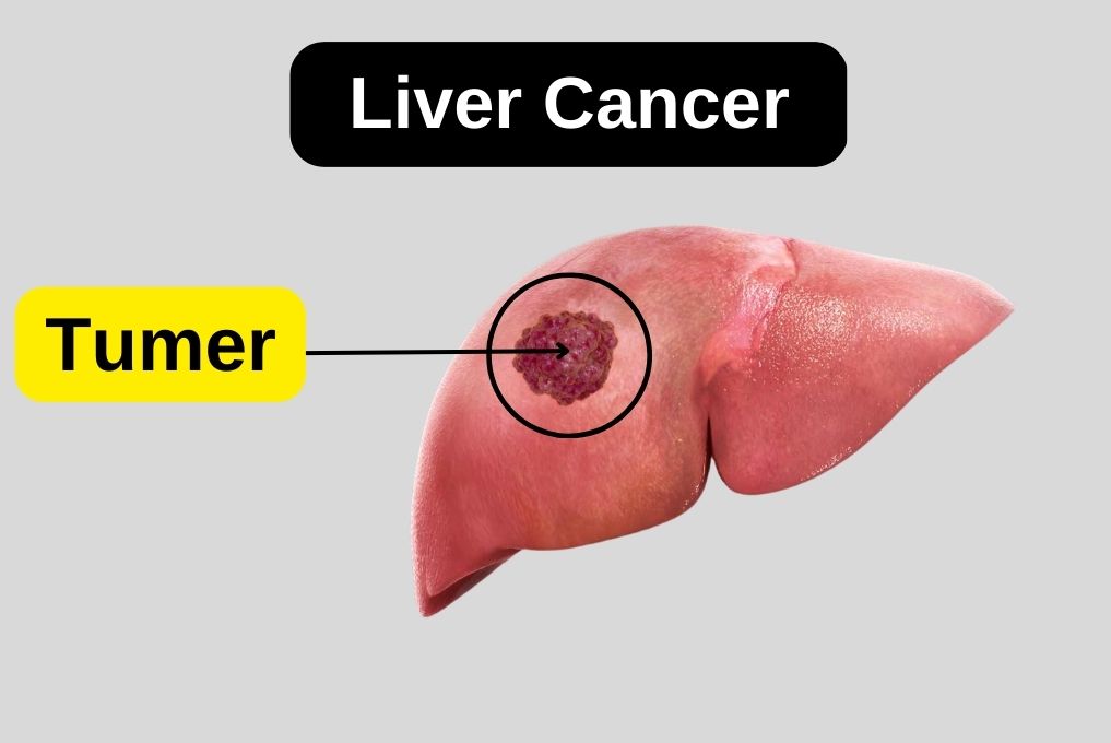 Ini kuvimba ni hatua mbaya ya ugonjwa sugu wa ini - husababisha ini kupata kovu sugu, cirrhosis ya ini na Saratani au Kansa ya ini.