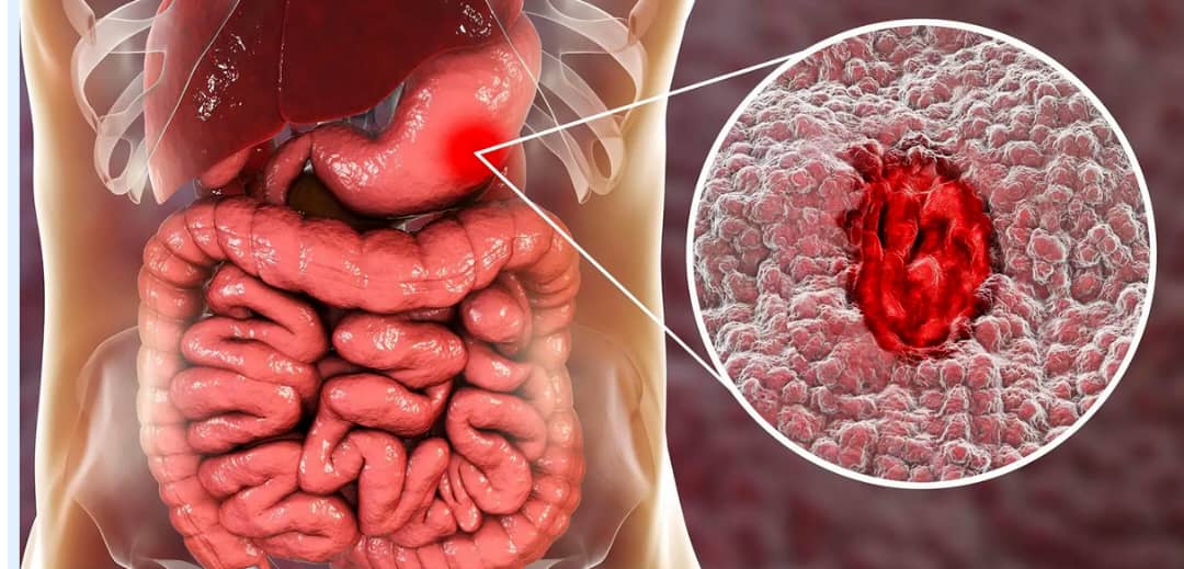 Ugonjwa wa Vidonda vya tumbo na magonjwa sugu ya mfumo wa chakula